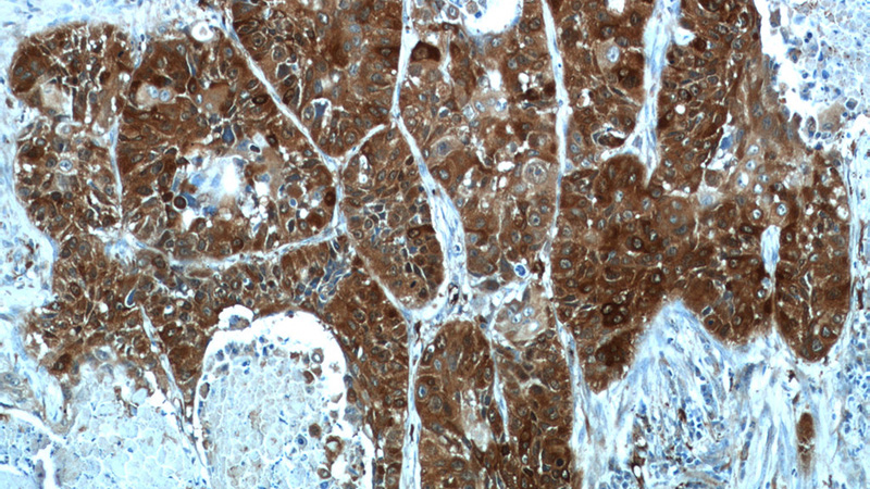 Immunohistochemistry of paraffin-embedded human lung cancer tissue slide using Catalog No:115602(SRX1 Antibody) at dilution of 1:50 (under 10x lens)