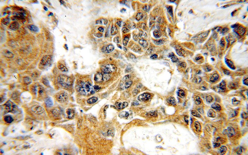 Immunohistochemical of paraffin-embedded human oesophagus cancer using Catalog No:113148(NEFH antibody) at dilution of 1:50 (under 40x lens)