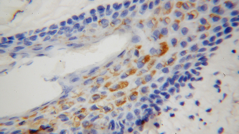 Immunohistochemical of paraffin-embedded human skin cancer using Catalog No:114952(S100B antibody) at dilution of 1:100 (under 40x lens)