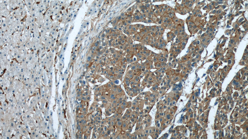 Immunohistochemical of paraffin-embedded human liver cancer using Catalog No:114791(RP2 antibody) at dilution of 1:50 (under 10x lens)