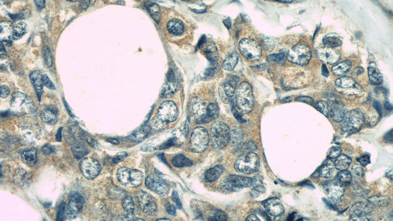 Immunohistochemistry of paraffin-embedded human breast cancer slide using Catalog No:113496(PAK1 Antibody) at dilution of 1:50