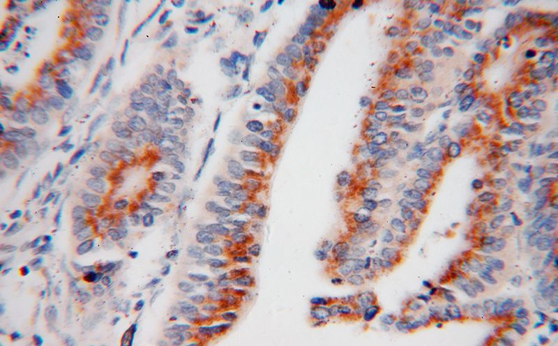 Immunohistochemical of paraffin-embedded human stomach cancer using Catalog No:111164(GS28 antibody) at dilution of 1:50 (under 40x lens)