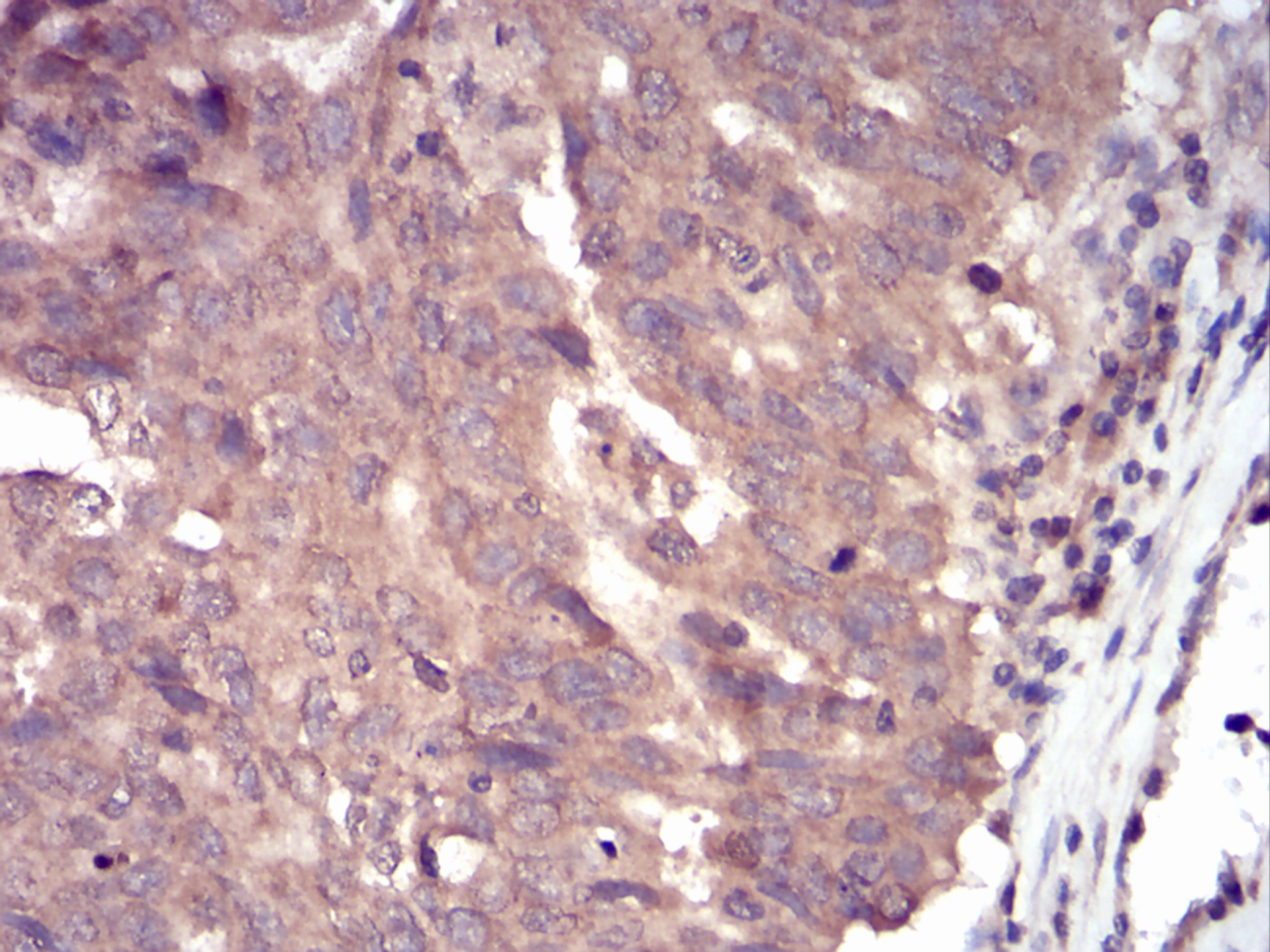Fig1: Immunohistochemical analysis of paraffin-embedded human ovarian cancer tissue using anti- Slingshot homolog 1 antibody. Counter stained with hematoxylin.