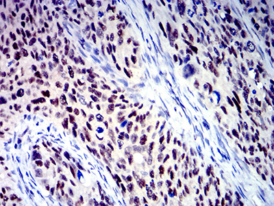 Fig3: Immunohistochemical analysis of paraffin-embedded cervical cancer tissue using anti-BCL9L antibody. The section was pre-treated using heat mediated antigen retrieval with Tris-EDTA buffer (pH 8.0) for 20 minutes. The tissues were blocked in 5% BSA for 30 minutes at room temperature, washed with ddH2O and PBS, and then probed with the primary antibody ( 1/100) for 30 minutes at room temperature. The detection was performed using an HRP conjugated compact polymer system. DAB was used as the chromogen. Tissues were counterstained with hematoxylin and mounted with DPX.