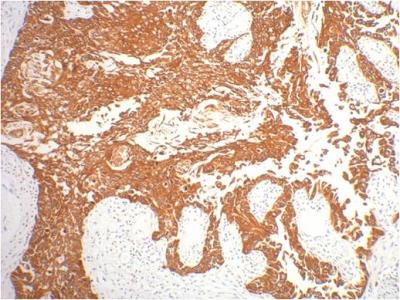 IHC staining of human gullet cancer tissue with CK16 mouse mAb(6F6) diluted at 1:200.