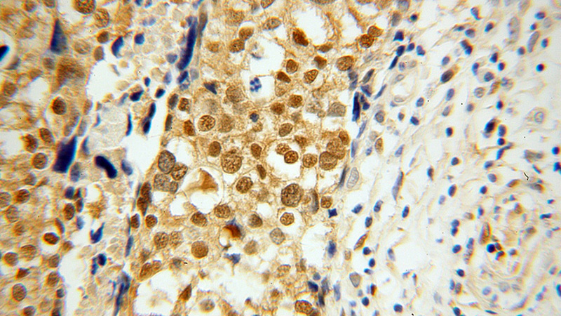 Immunohistochemical of paraffin-embedded human ovary tumor using Catalog No:116880(YAP1 antibody) at dilution of 1:100 (under 40x lens)