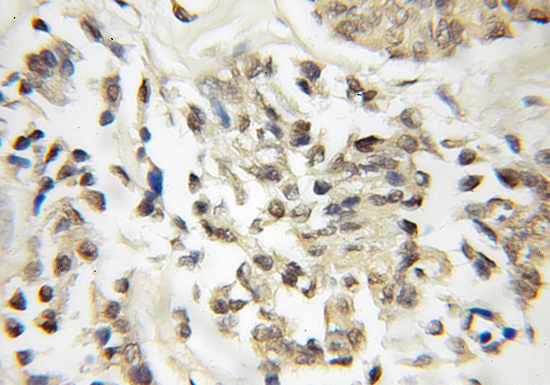 Immunohistochemical of paraffin-embedded human breast cancer using Catalog No:110056(DOM3Z antibody) at dilution of 1:50 (under 25x lens)