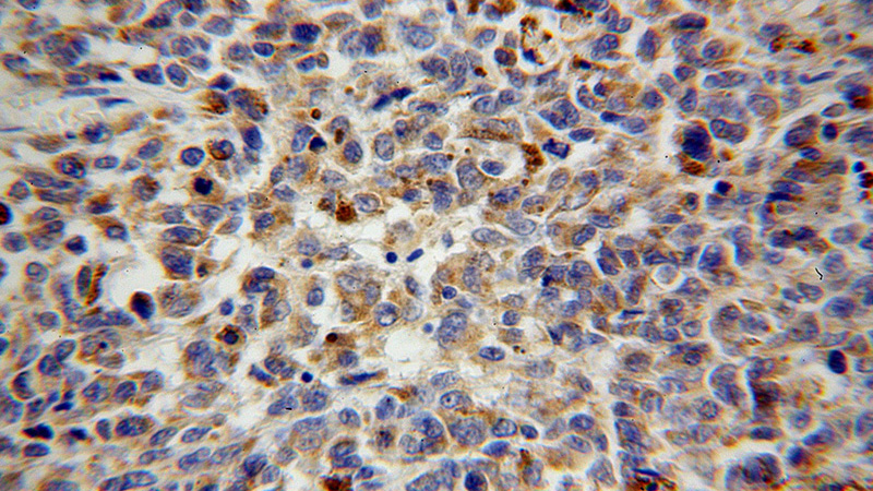 Immunohistochemical of paraffin-embedded human malignant melanoma using Catalog No:116808(VTI1B antibody) at dilution of 1:100 (under 40x lens)