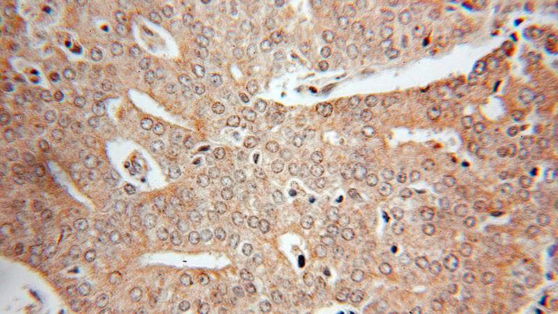 Immunohistochemical of paraffin-embedded human prostate cancer using Catalog No:110860(GAMT antibody) at dilution of 1:10 (under 25x lens)