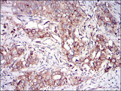 Immunohistochemical analysis of paraffin-embedded cervical cancer tissues using EIF2AK2 mouse mAb with DAB staining.