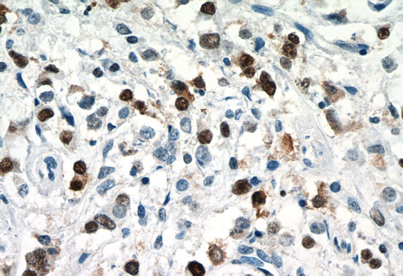 Immunohistochemistry of paraffin-embedded human breast cancer tissue slide using Catalog No:113744(PCNA Antibody) at dilution of 1:400 (under 40x lens)