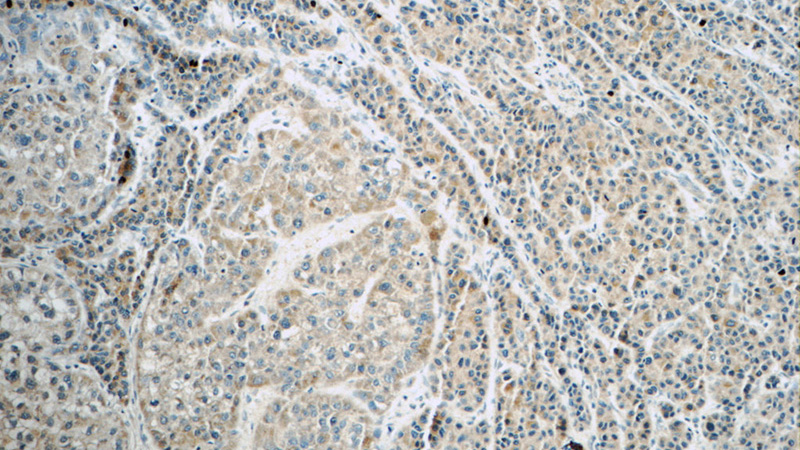 Immunohistochemistry of paraffin-embedded human liver cancer tissue slide using Catalog No:110720(FREM1 Antibody) at dilution of 1:50 (under 10x lens)