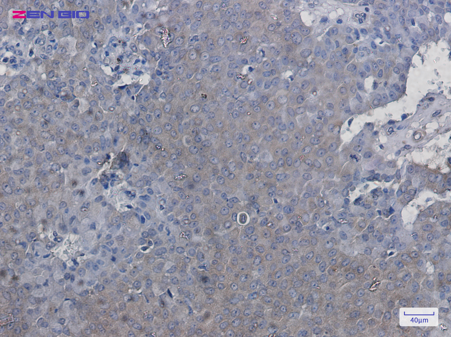 Immunohistochemistry of mTOR (Phospho-Ser2448) in paraffin-embedded Human breast cancer tissue using mTOR (Phospho-Ser2448) Rabbit pAb at dilution 1/50