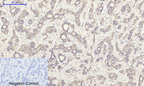 Immunohistochemical analysis of paraffin-embedded Human-liver-cancer tissue. 1,PI 3-kinase p85α (phospho Tyr607) Polyclonal Antibody was diluted at 1:200(4°C,overnight). 2, Sodium citrate pH 6.0 was used for antibody retrieval(>98°C,20min). 3,Secondary antibody was diluted at 1:200(room tempeRature, 30min). Negative control was used by secondary antibody only.