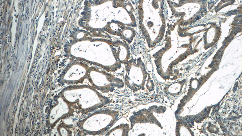 Immunohistochemistry of paraffin-embedded human colon cancer tissue slide using Catalog No:108844(CAPZA1 Antibody) at dilution of 1:50 (under 10x lens)