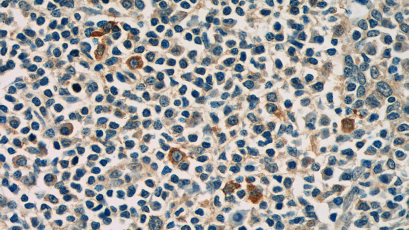 Immunohistochemistry of paraffin-embedded human tonsillitis tissue slide using Catalog No:112063(KIR3DX1 Antibody) at dilution of 1:50 (under 40x lens)