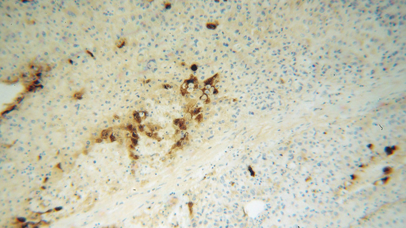 Immunohistochemical of paraffin-embedded human liver cancer using Catalog No:108038(APOH antibody) at dilution of 1:100 (under 10x lens)