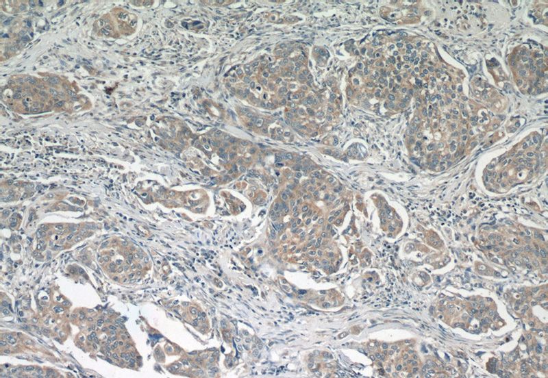 Immunohistochemistry of paraffin-embedded human cervical cancer tissue slide using Catalog No:114107(PPP2R5E Antibody) at dilution of 1:50 (under 10x lens)