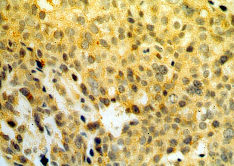 Immunohistochemical of paraffin-embedded human ovary tumor using Catalog No:114844(RPS3 antibody) at dilution of 1:50 (under 40x lens)