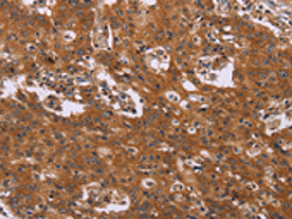 The image is immunohistochemistry of paraffin-embedded Human gastric cancer tissue using 166797(CMTM6 Antibody) at dilution 1/40, on the right is treated with synthetic peptide. (Original magnification: ×200)