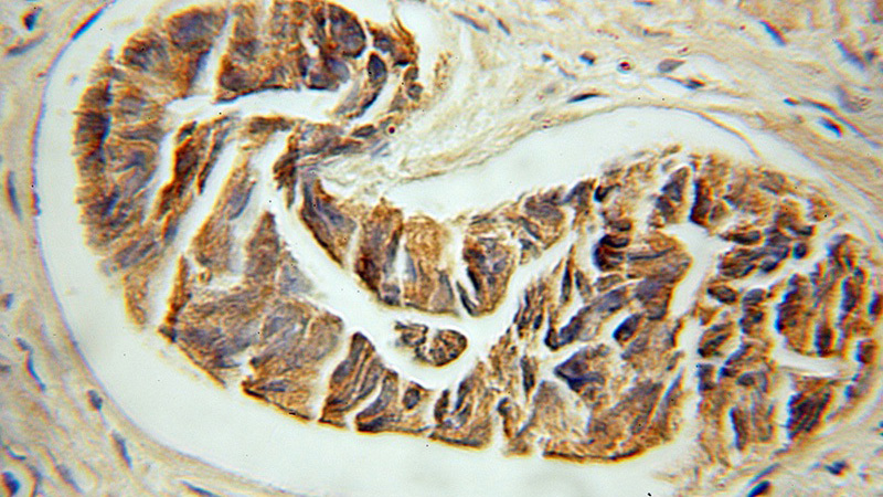 Immunohistochemical of paraffin-embedded human prostate cancer using Catalog No:112130(KRT33B antibody) at dilution of 1:50 (under 10x lens)