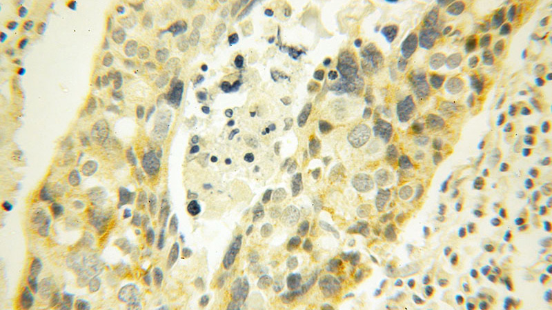 Immunohistochemical of paraffin-embedded human ovary tumor using Catalog No:112829(MRPL45 antibody) at dilution of 1:100 (under 40x lens)