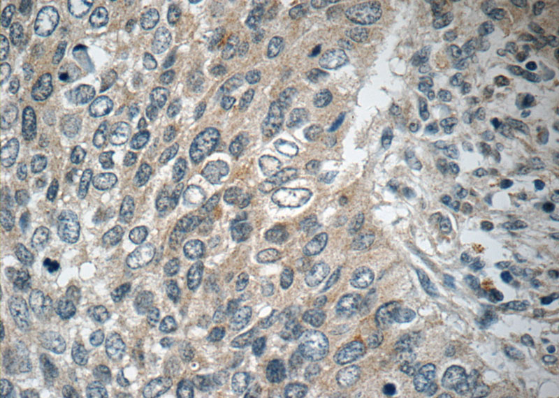 Immunohistochemistry of paraffin-embedded human cervical cancer tissue slide using Catalog No:114056(POM121 Antibody) at dilution of 1:50 (under 40x lens)
