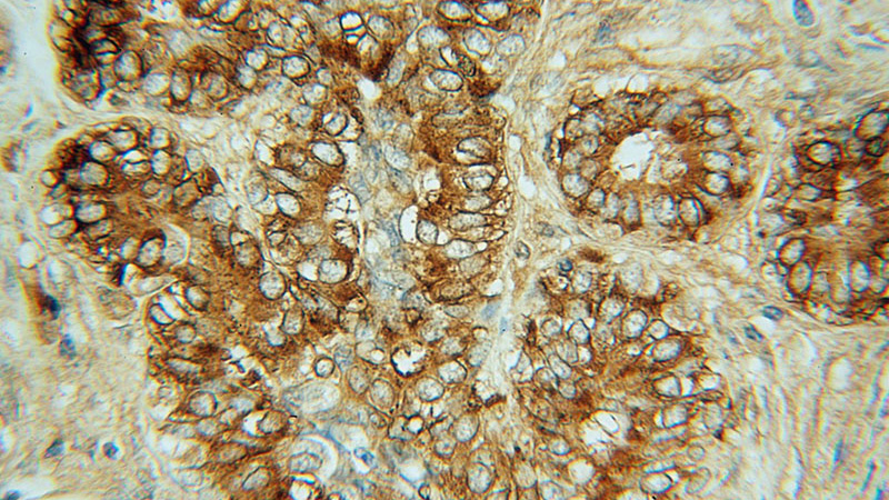 Immunohistochemical of paraffin-embedded human breast cancer using Catalog No:109724(CTHRC1 antibody) at dilution of 1:50 (under 40x lens)