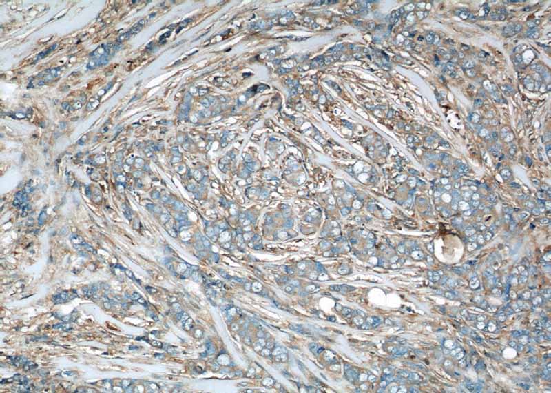 Immunohistochemical of paraffin-embedded human breast cancer using Catalog No:114663(ARHGDIA,aGDI antibody) at dilution of 1:50 (under 10x lens)