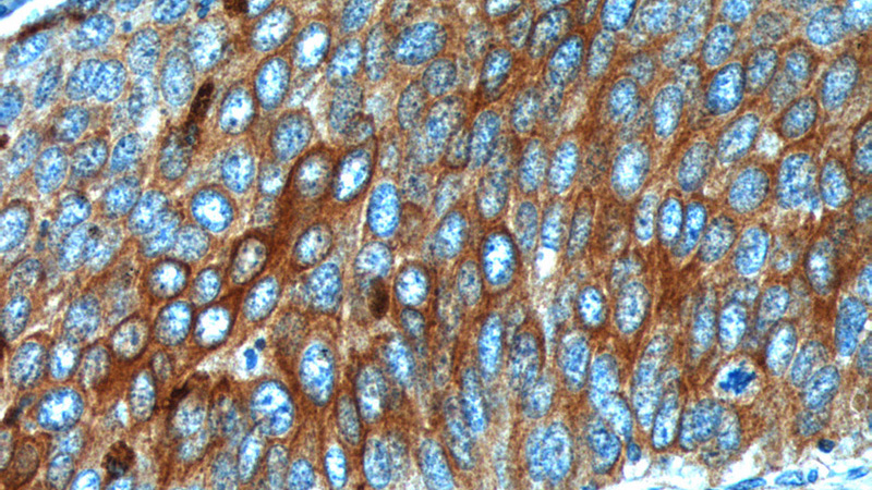 Immunohistochemistry of paraffin-embedded human cervical cancer tissue slide using Catalog No:109796(KRT17 Antibody) at dilution of 1:200 (under 40x lens).