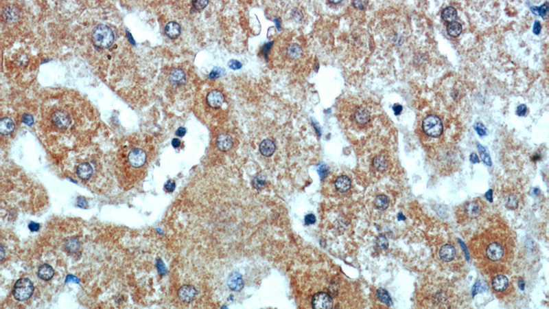 Immunohistochemical of paraffin-embedded human liver cancer using Catalog No:108608(C16orf70 antibody) at dilution of 1:100 (under 40x lens)