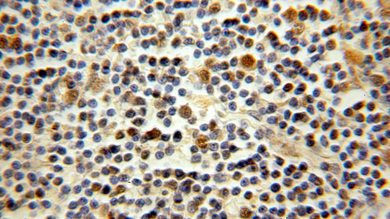 Immunohistochemical of paraffin-embedded human lymphoma using Catalog No:112249(STK11 antibody) at dilution of 1:50 (under 10x lens)