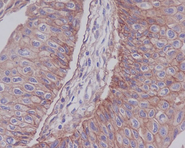 Immunohistochemical analysis of paraffin-embedded human bladder carcinoma, using Integrin beta 1 Antibody.