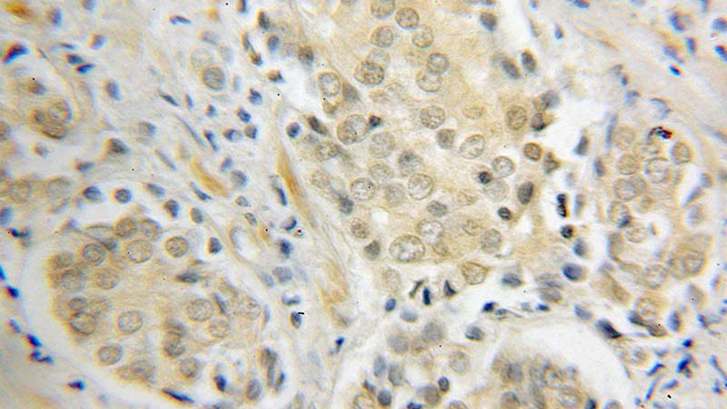 Immunohistochemical of paraffin-embedded human prostate cancer using Catalog No:114065(POT1 antibody) at dilution of 1:100 (under 25x lens)