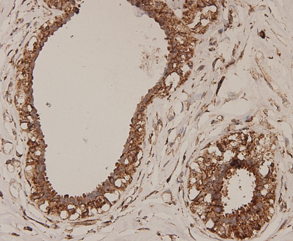 Fig3: Immunohistochemical analysis of paraffin-embedded human breast carcinoma tissue using anti-ERAS antibody. The section was pre-treated using heat mediated antigen retrieval with Tris-EDTA buffer (pH 8.0-8.4) for 20 minutes.The tissues were blocked in 5% BSA for 30 minutes at room temperature, washed with ddH2O and PBS, and then probed with the antibody at 1/100 dilution, for 30 minutes at room temperature and detected using an HRP conjugated compact polymer system. DAB was used as the chrogen. Counter stained with hematoxylin and mounted with DPX.
