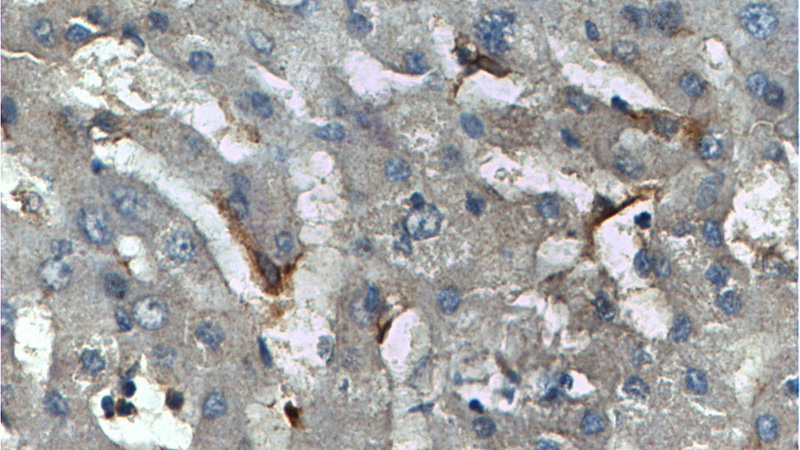 Immunohistochemistry of paraffin-embedded human liver tissue slide using (CD68 Antibody) at dilution of 1:200 (under 40x lens)