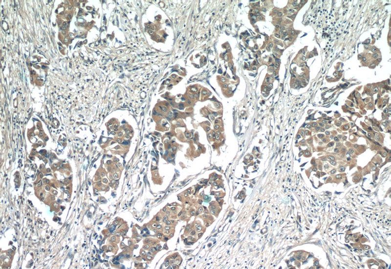 Immunohistochemistry of paraffin-embedded human breast cancer tissue slide using Catalog No:107074(AZGP1 Antibody) at dilution of 1:50 (under 10x lens)