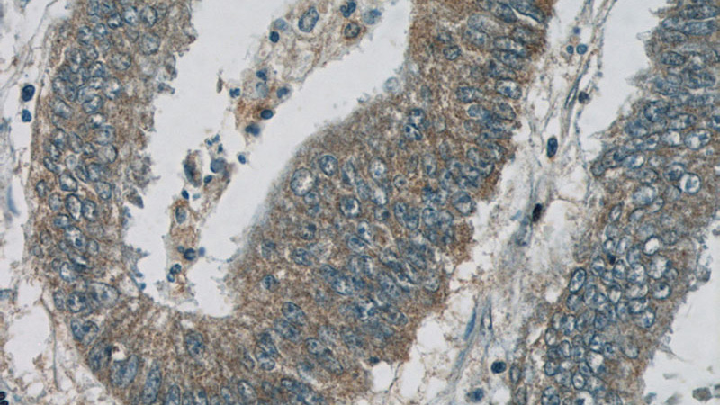 Immunohistochemistry of paraffin-embedded human colon cancer tissue slide using Catalog No:113221(C5orf23 Antibody) at dilution of 1:50 (under 40x lens)