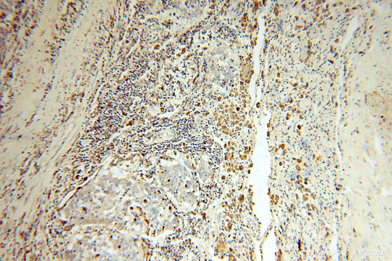 Immunohistochemical of paraffin-embedded human lung cancer using Catalog No:114287(PSAP antibody) at dilution of 1:200 (under 10x lens)