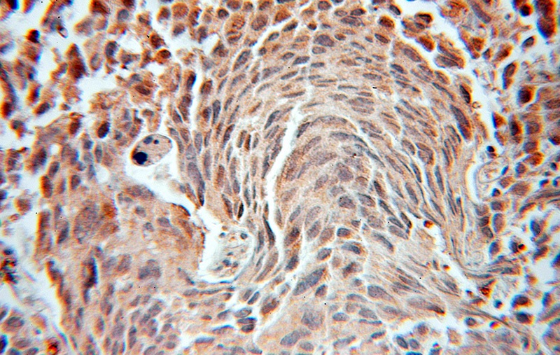 Immunohistochemical of paraffin-embedded human prostate cancer using Catalog No:110615(FEM1B antibody) at dilution of 1:50 (under 10x lens)