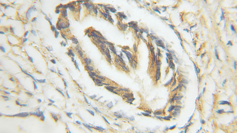Immunohistochemical of paraffin-embedded human prostate cancer using Catalog No:110673(FKBP2 antibody) at dilution of 1:50 (under 10x lens)