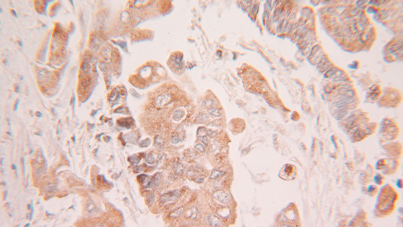 Immunohistochemical of paraffin-embedded human colon cancer using Catalog No:112711(UBE2V2 antibody) at dilution of 1:100 (under 25x lens)