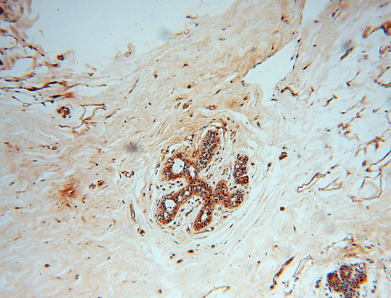 Immunohistochemical of paraffin-embedded human colon cancer using Catalog No:111246(OLA1 antibody) at dilution of 1:50 (under 10x lens)