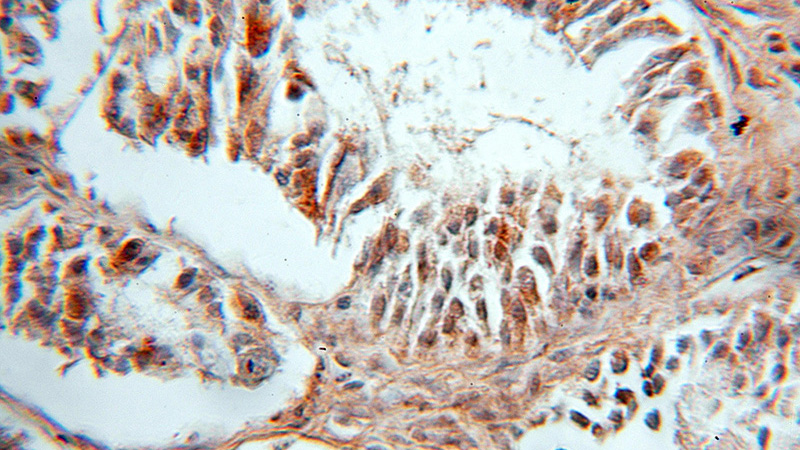 Immunohistochemical of paraffin-embedded human ovary tumor using Catalog No:108026(APOBEC3C antibody) at dilution of 1:10 (under 10x lens)