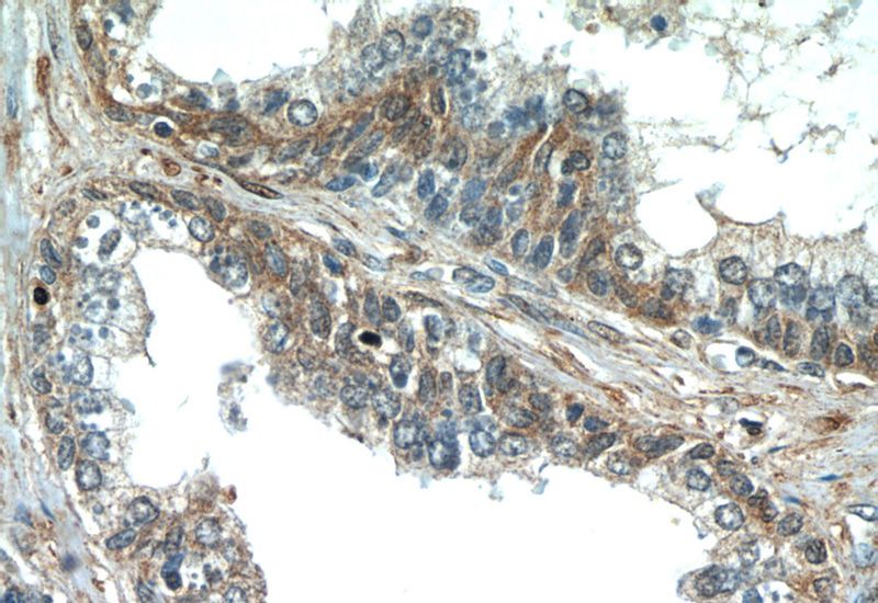 Immunohistochemistry of paraffin-embedded human prostate hyperplasia tissue slide using Catalog No:113490(PAGE2 Antibody) at dilution of 1:50 (under 40x lens)