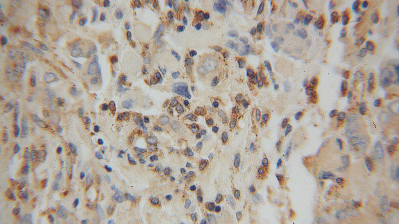 Immunohistochemical of paraffin-embedded human gliomas using Catalog No:111957(ITPKA antibody) at dilution of 1:100 (under 40x lens)