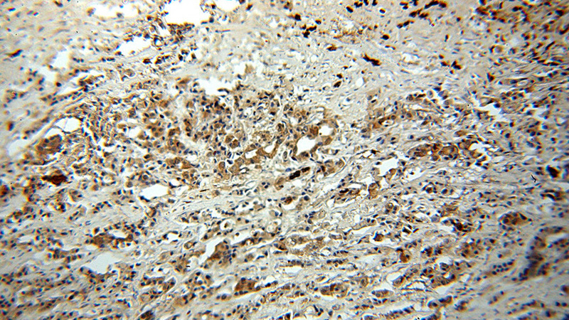 Immunohistochemical of paraffin-embedded human breast cancer using Catalog No:114966(S100A9 antibody) at dilution of 1:100 (under 10x lens)