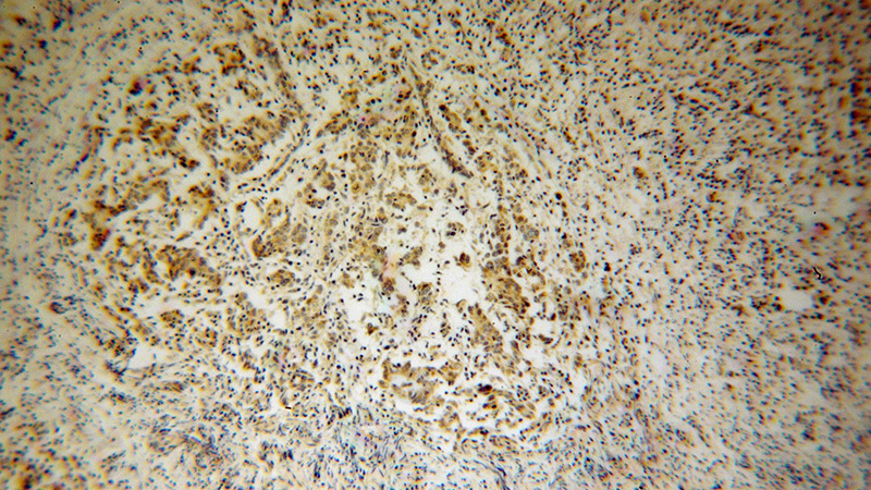 Immunohistochemical of paraffin-embedded human breast cancer using Catalog No:115033(SDHC antibody) at dilution of 1:100 (under 10x lens)