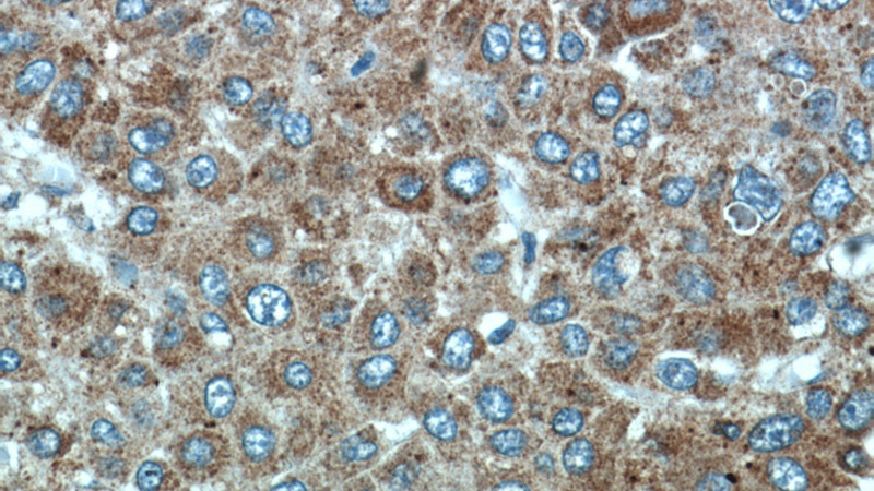 Immunohistochemical of paraffin-embedded human liver cancer using Catalog No:115996(TFAM antibody) at dilution of 1:50 (under 40x lens)
