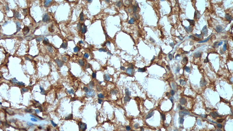 Immunohistochemistry of paraffin-embedded human renal cell carcinoma tissue slide using Catalog No:107030(CA9 Antibody) at dilution of 1:400 (under 40x lens). heat mediated antigen retrieved with Tris-EDTA buffer(pH9).